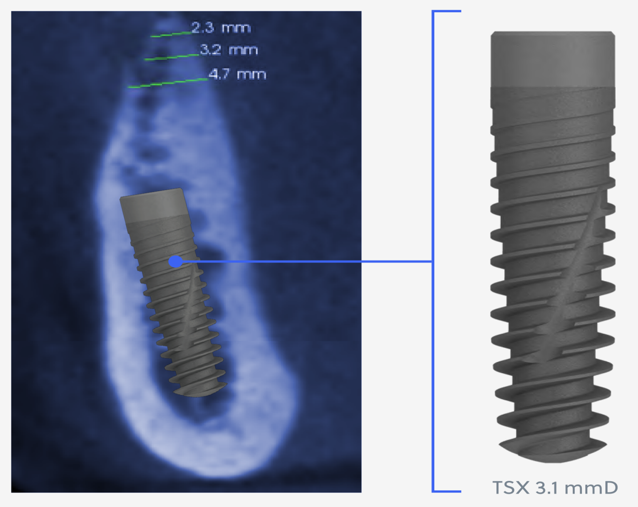 TSX Implants - 3.1mmD